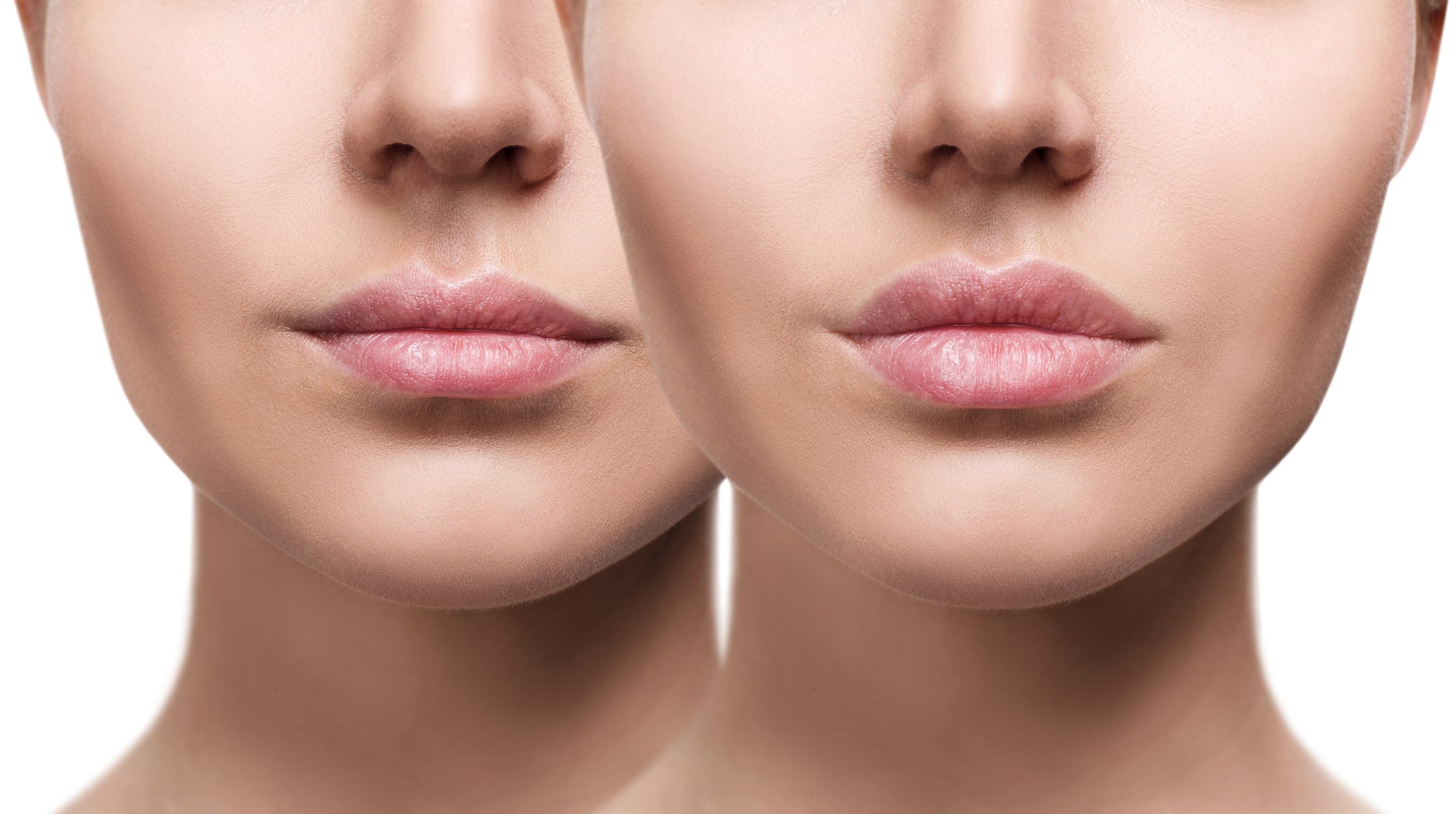 Vorher/Nachher Bild einer Lippenvergrößerung