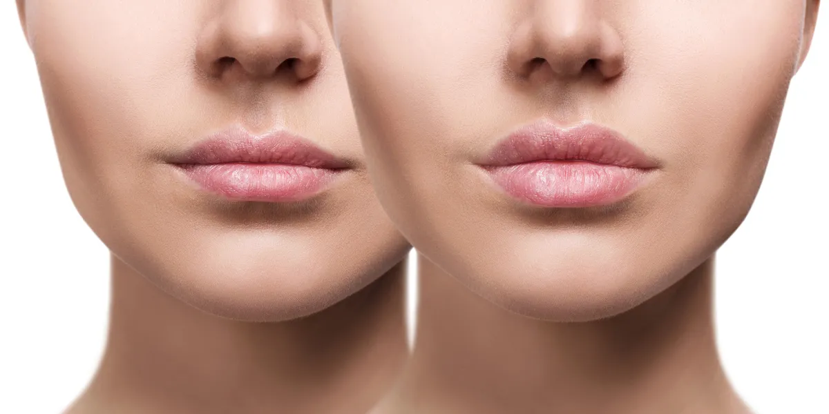 Lippen Aufspritzen Munchen Lippenvergrosserung Bei Aesthetic And Soul
