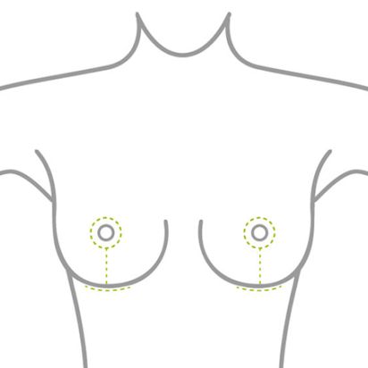 Grafik Schnittführung Brustverkleinerung und Bruststraffung