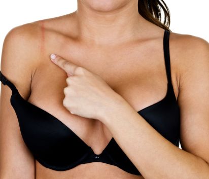 Brustverkleinerung München - brünette Frau mit einer verkleinerten Brust