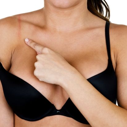 Brustverkleinerung München - brünette Frau mit einer verkleinerten Brust